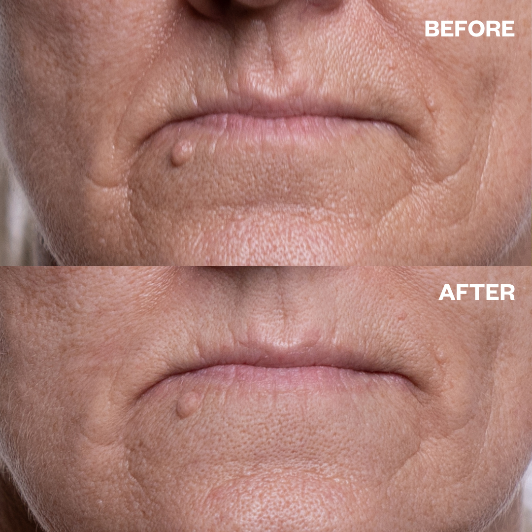 Wrinkles Schminkles Mouth Wrinkle Patches