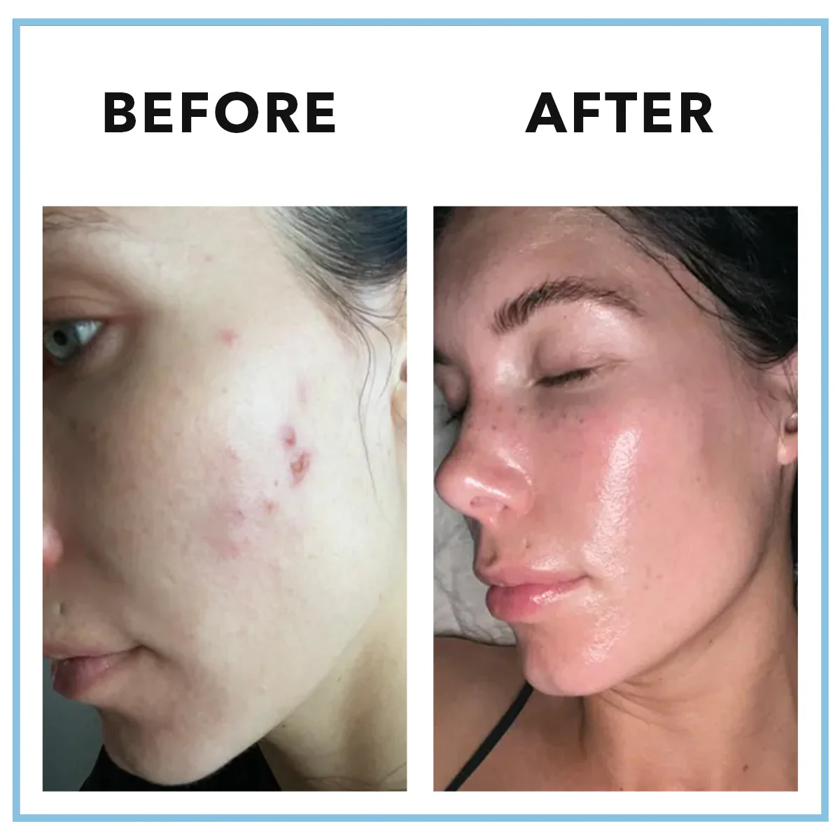 MINDBODYSKIN™ Hormonal Acne Supplement