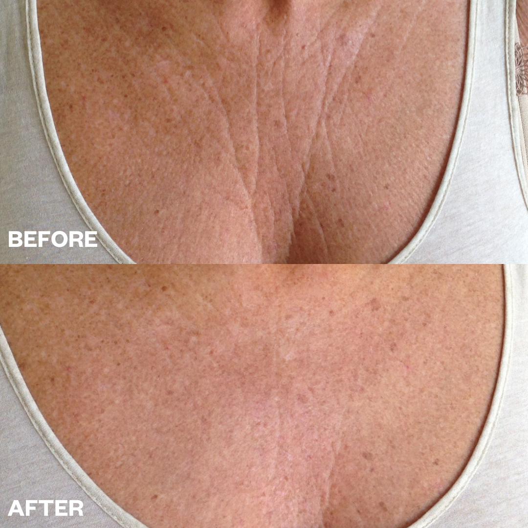Wrinkles Schminkles Chest Wrinkle Patch